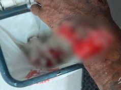 Atacado com facão, homem quase perdeu a mão em Campo Grande