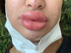 Mulher fica com rosto deformado após procedimento que custou R$ 1 mil
