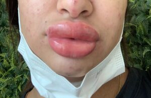 Mulher fica com rosto deformado após procedimento que custou R$ 1 mil