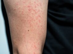 Primavera do Leste confirma terceiro caso de sarampo e intensifica vacinação na cidade