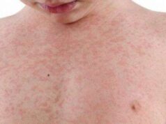 Várzea Grande mantém vigilância após resultado positivo preliminar para sarampo – Várzea Grande mantém vigilância após resultado positivo preliminar para sarampo