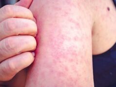 Várzea Grande realiza nova coleta para confirmar ou descartar caso suspeito de sarampo – Várzea Grande realiza nova coleta para confirmar ou descartar caso suspeito de sarampo