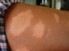 Cuiabá intensifica ações para diagnóstico precoce e tratamento da hanseníase