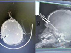 Menina que teve carregador de celular cravado na testa recebe alta